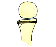Figura 12. Injerto óseo fijado con un tornillo en la glenoides anterior