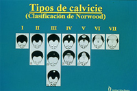 Tipos calvicie