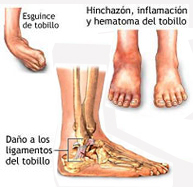 Lesiones ligamentosas del tobillo