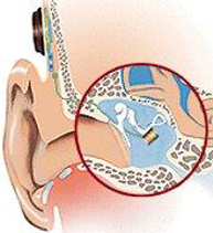 Implante de oído medio