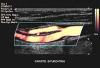 La imagen de la bifurcación de la carótida ultrasonido Doppler