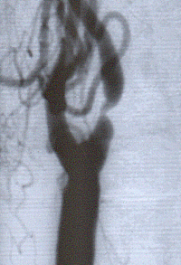 Imagen de la estenosis de la arteria carótida en la angiografía