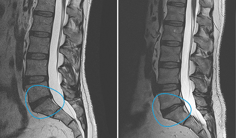 terapida-celular-avanzada-para-la-discopatia-lumbar