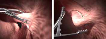 Reduccion De Estomago Via Endoscopia Pose Centro Medico Teknon