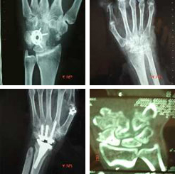 Artrosis de la mano  Centro Médico Teknon