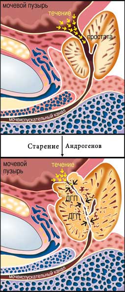 Prostata-russian
