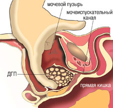 Prostata russian 2