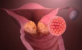 virus del papiloma humano